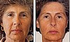 Micro Current Facial Lifting